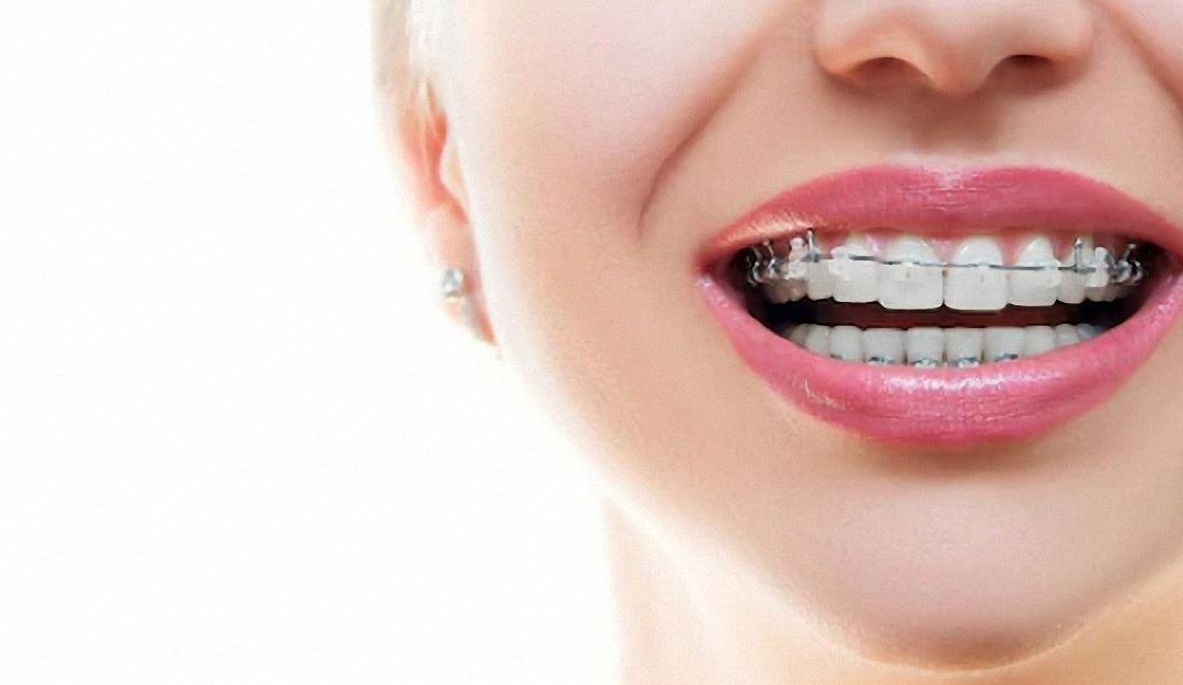 Qué es el tratamiento de ortodoncia